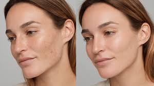 Tretinoin before and after results with best face oil for hydration