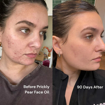 Prickly Pear Oil for Skin